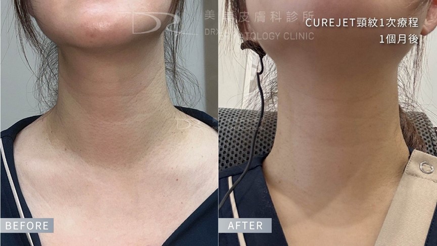 脖子美白?頸紋霜有用嗎?如何選擇適合的頸部保養成分? 脖子美白?頸紋霜有用嗎?如何選擇適合的頸部保養成分?