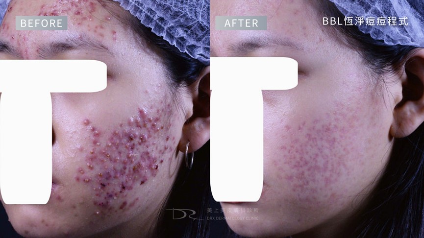 紅痘疤擦什麼保養品?痘痘泛紅怎麼辦? 紅痘疤擦什麼保養品?痘痘泛紅怎麼辦?