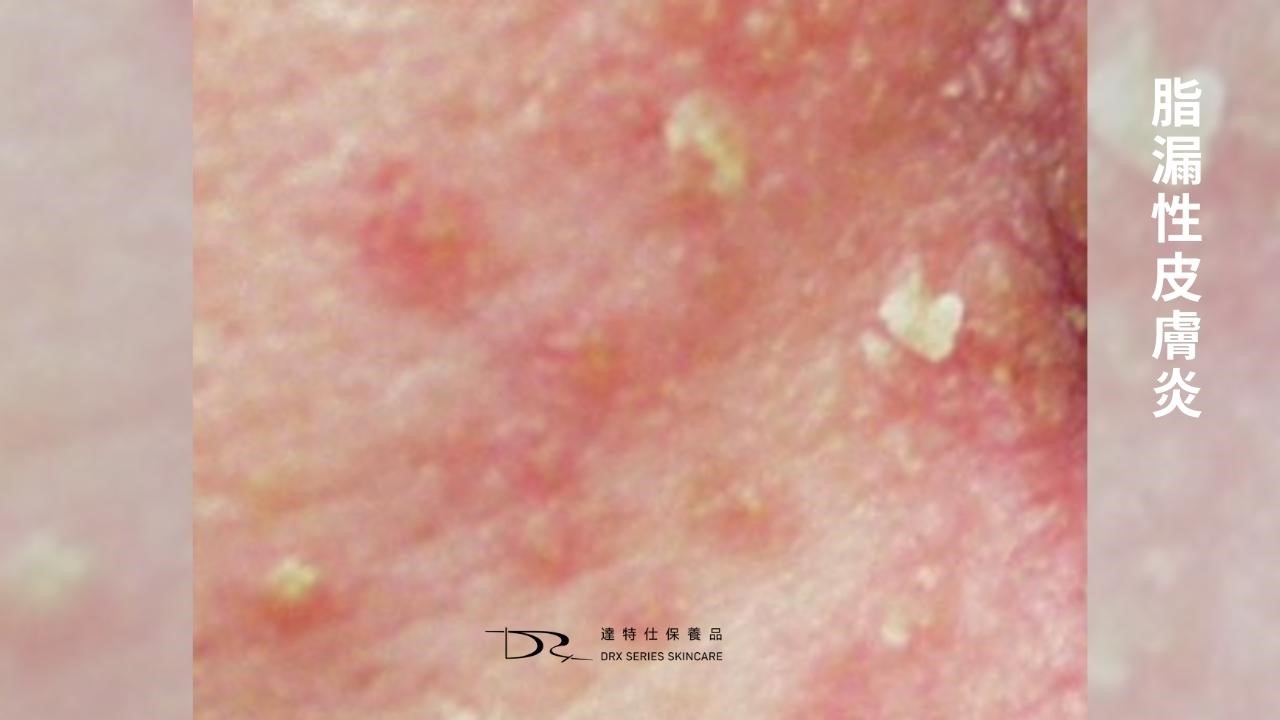 又到了換季的時節！隨著天氣逐漸變冷，你會不會覺得臉常常會乾乾癢癢的呢？今天就讓我們來探討不同膚質該在換季時怎麼保養吧！換季的肌膚保養品推薦都在這一篇文章！