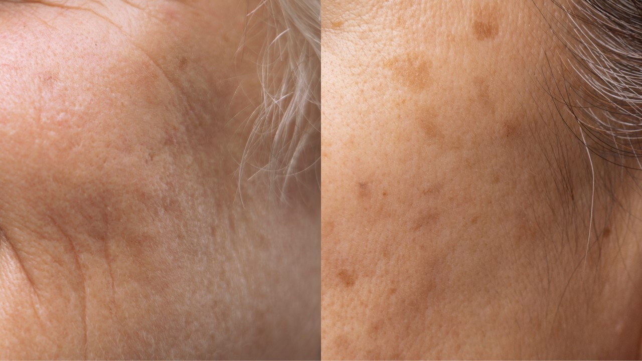 想靠吃一些天然食物來促進膠原蛋白增生嗎?今天就讓我們從「糖」的角度來談談哪些食物吃了可以幫助增加膠原蛋白、哪些則有反效果,因為有種東西叫「AGEs」(糖化終產物),會對我們皮膚有所影響,繼續看下去就知道囉! 想靠吃一些天然食物來促進膠原蛋白增生嗎?今天就讓我們從「糖」的角度來談談哪些食物吃了可以幫助增加膠原蛋白、哪些則有反效果,因為有種東西叫「AGEs」(糖化終產物),會對我們皮膚有所影響,繼續看下去就知道囉!