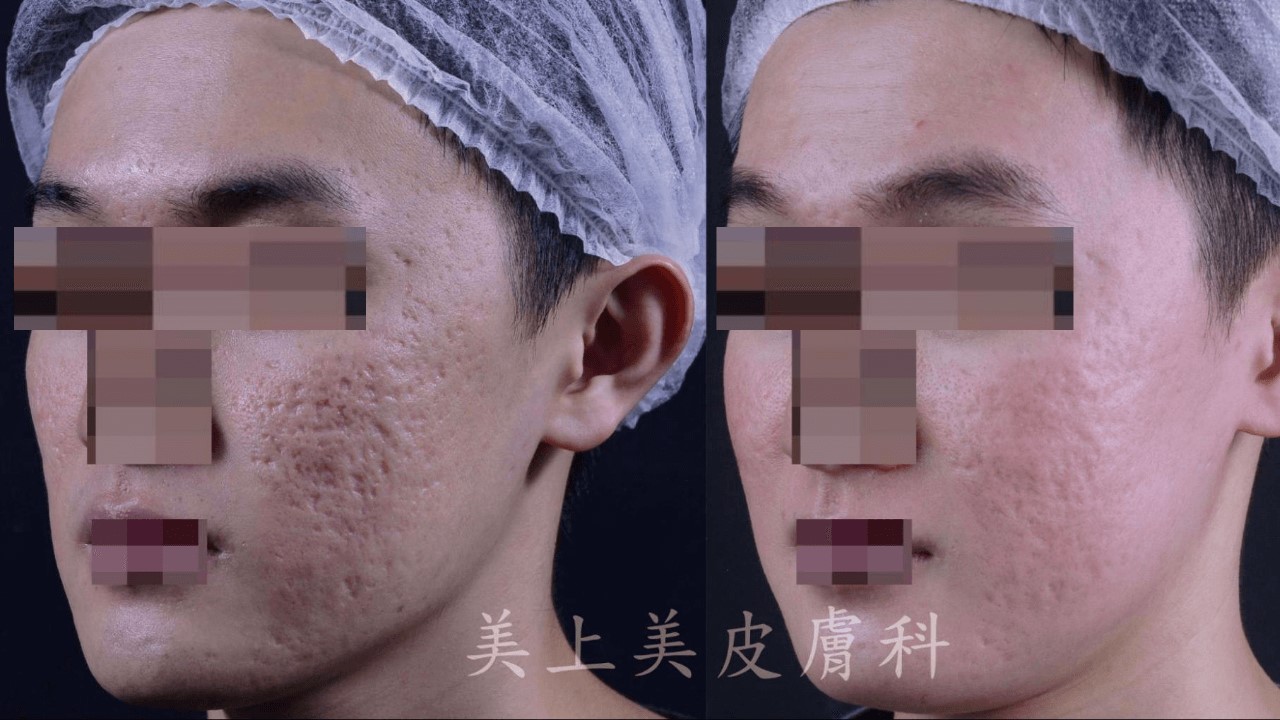 男生多久去一次角質？男生皮膚怎麼變好？男生護膚步驟秘訣？