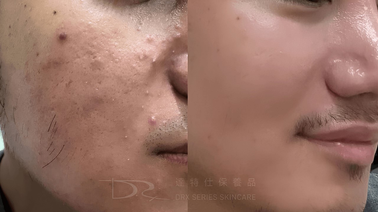 男生多久去一次角質？男生皮膚怎麼變好？男生護膚步驟秘訣？