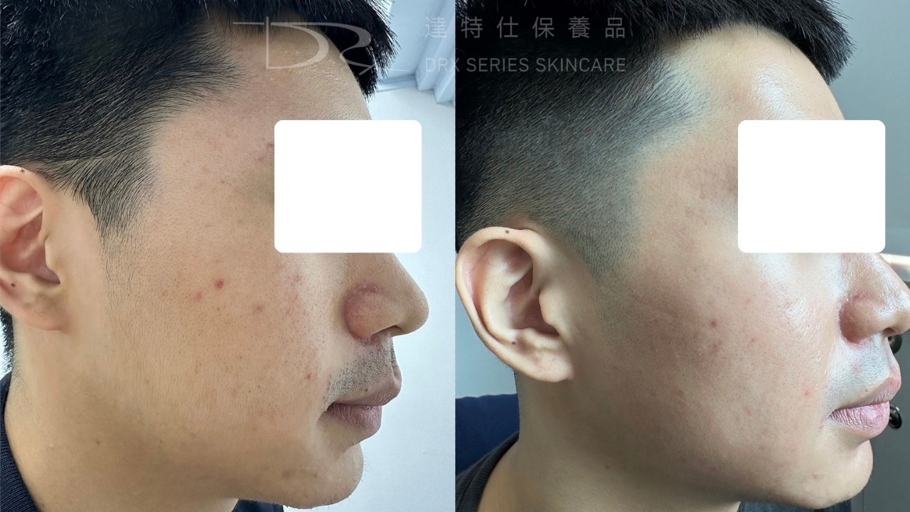 A 醇可以長期用嗎？毛孔粗大美白 A 醇用法，醫師教你「大 A、小 A」實用A醇擦法！