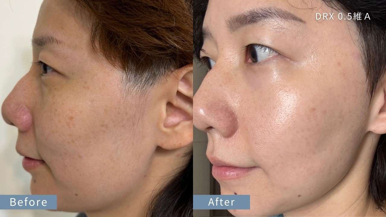 A 醇可以長期用嗎？毛孔粗大美白 A 醇用法，醫師教你「大 A、小 A」實用A醇擦法！