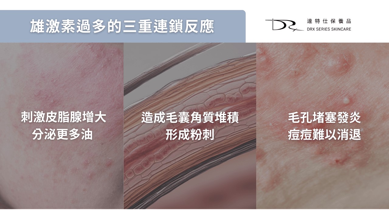 多囊痘痘怎麼辦?PCOS 痘痘原因與保養成分怎麼選 多囊痘痘怎麼辦?PCOS 痘痘原因與保養成分怎麼選