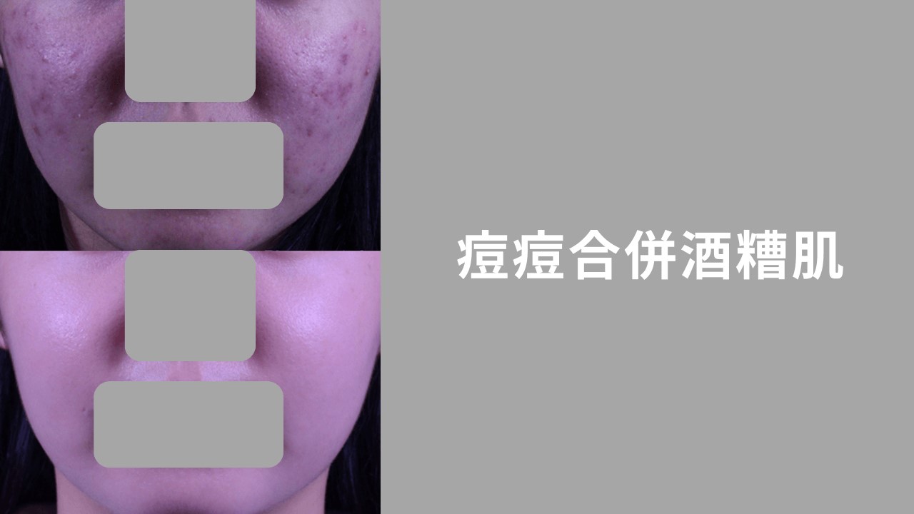 酒糟可以用B5嗎?酒糟A醛、酒糟水楊酸怎麼擦? 酒糟可以用B5嗎?酒糟A醛、酒糟水楊酸怎麼擦?