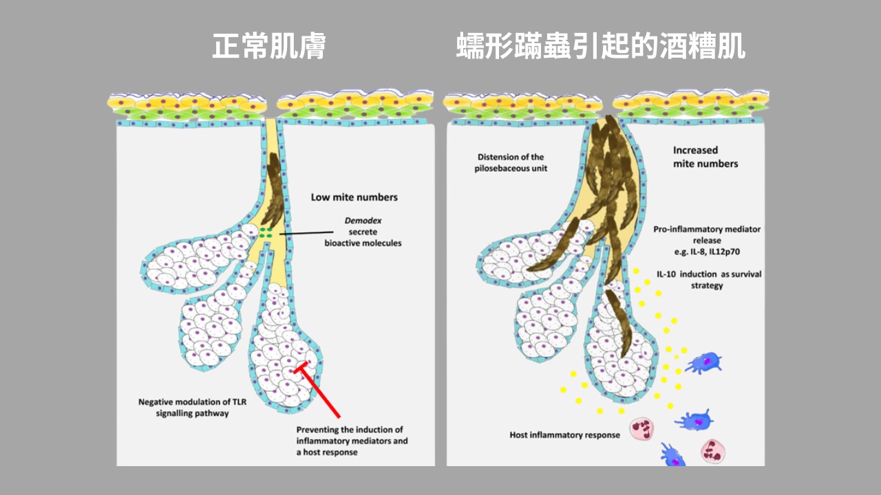 酒糟可以用B5嗎?酒糟A醛、酒糟水楊酸怎麼擦? 酒糟可以用B5嗎?酒糟A醛、酒糟水楊酸怎麼擦?