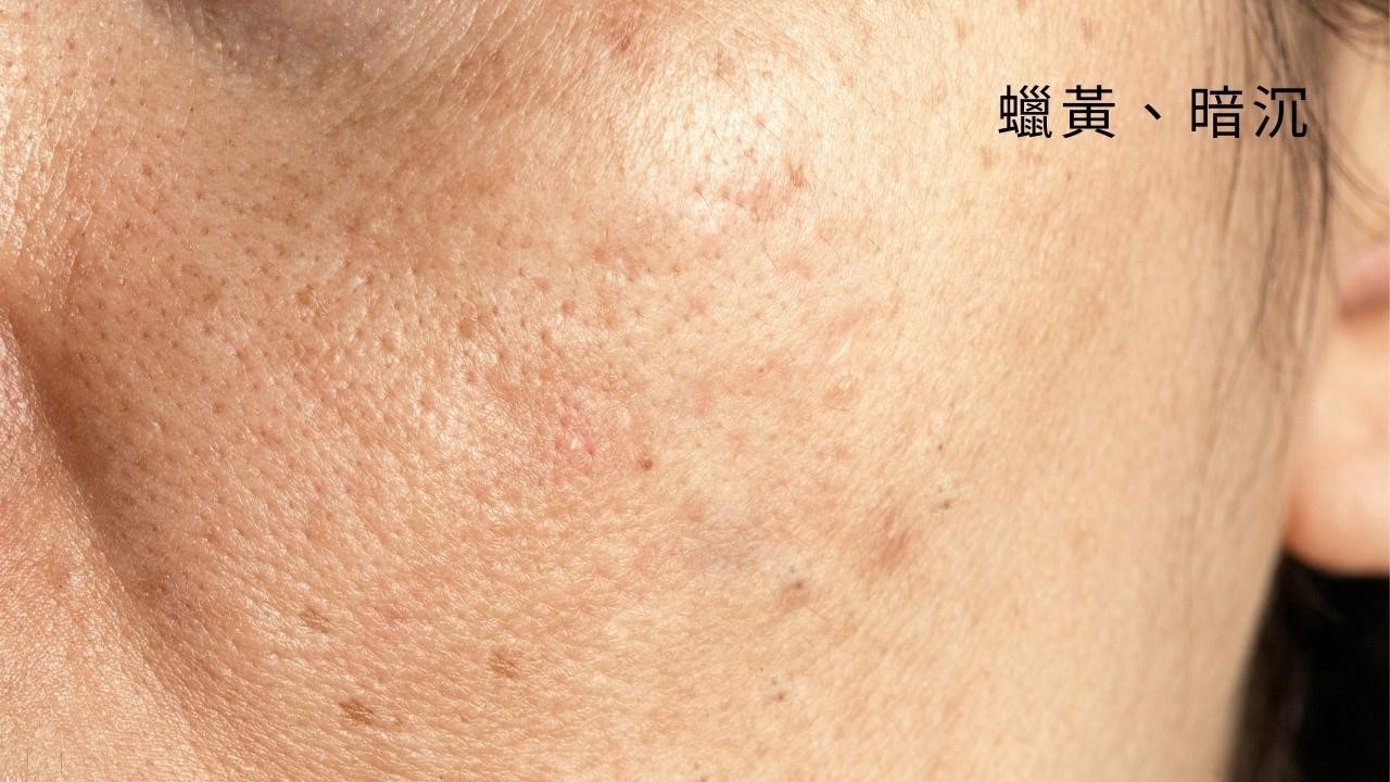 蠕形蟎蟲會傳染嗎? 蠕形蟎蟲會傳染嗎?