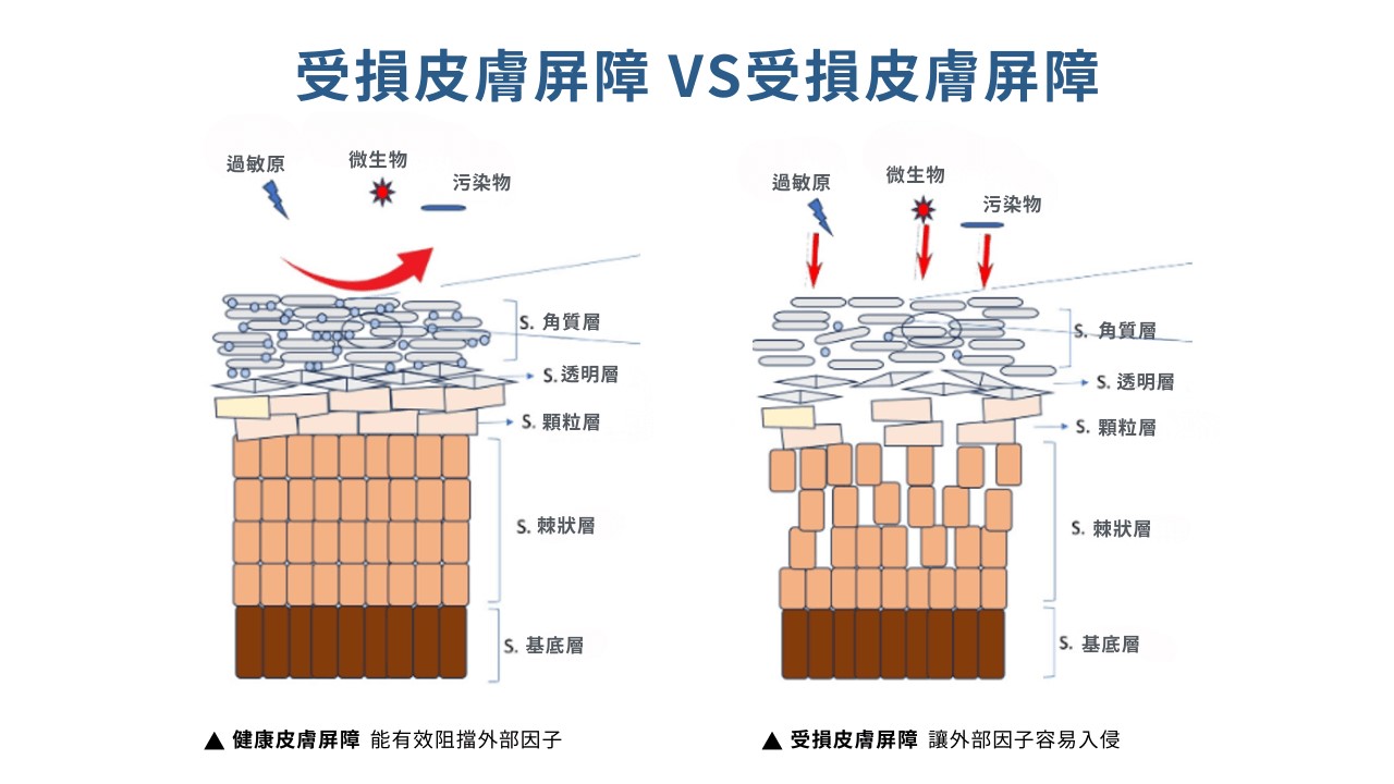 皮膚屏障受損症狀怎麼看?皮膚屏障受損原因有哪些? 皮膚屏障受損症狀怎麼看?皮膚屏障受損原因有哪些?