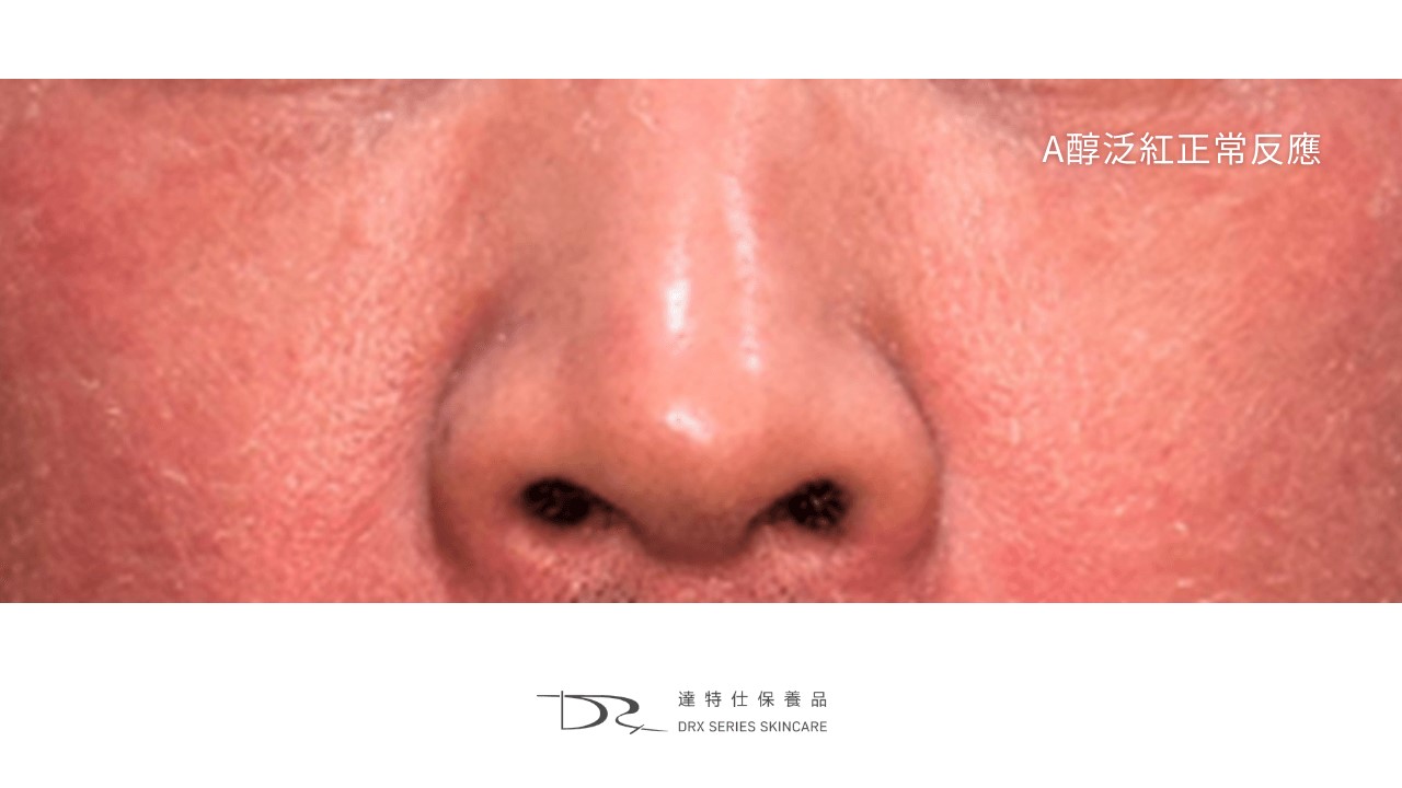 A醇泛紅的原因， A 醇紅腫怎麼辦？
