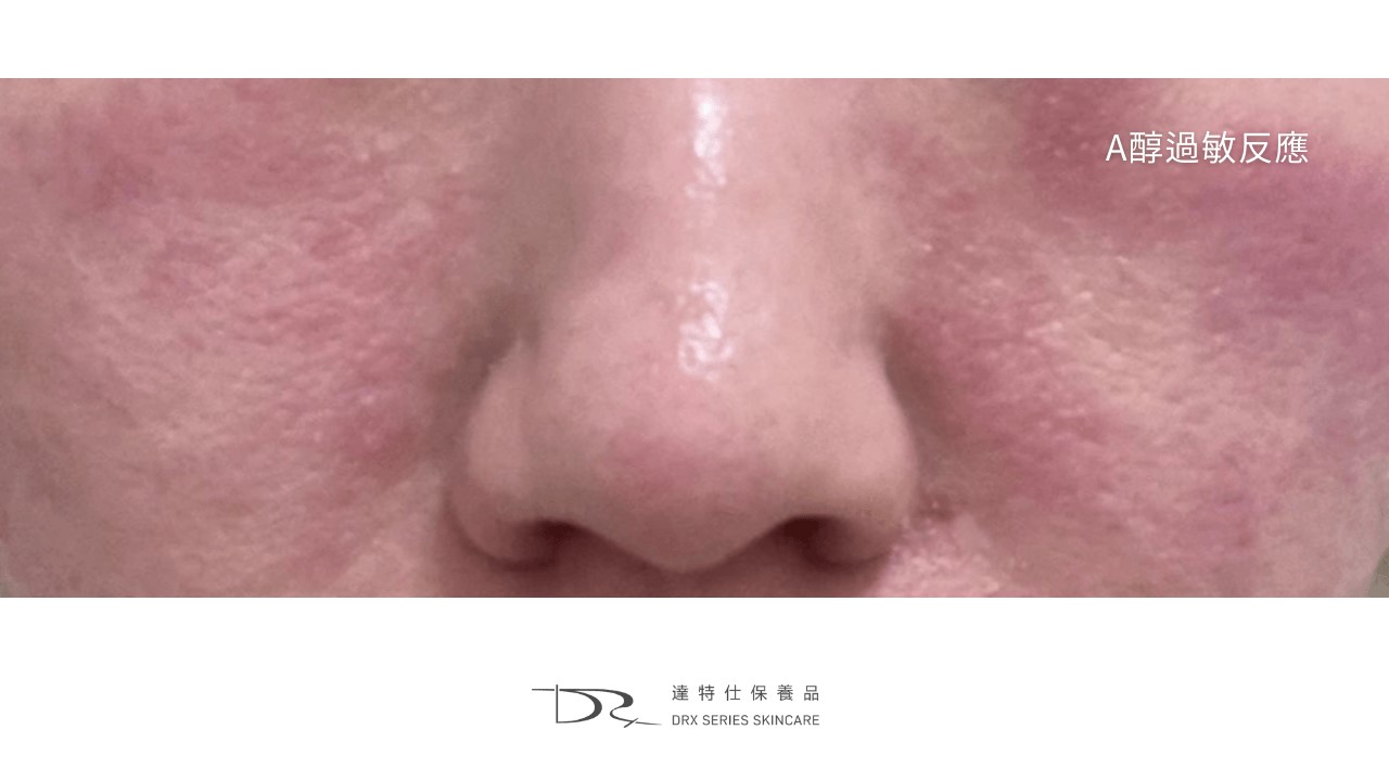 A醇泛紅的原因， A 醇紅腫怎麼辦？