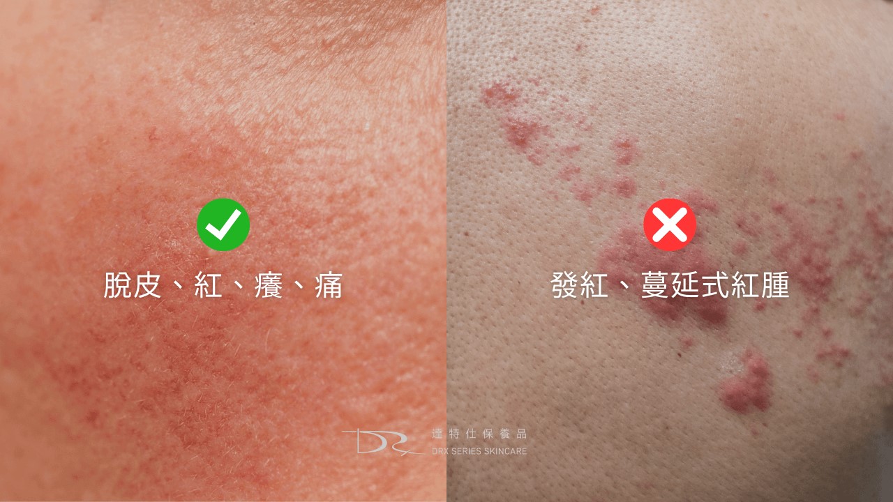 A醇泛紅的原因， A 醇紅腫怎麼辦？