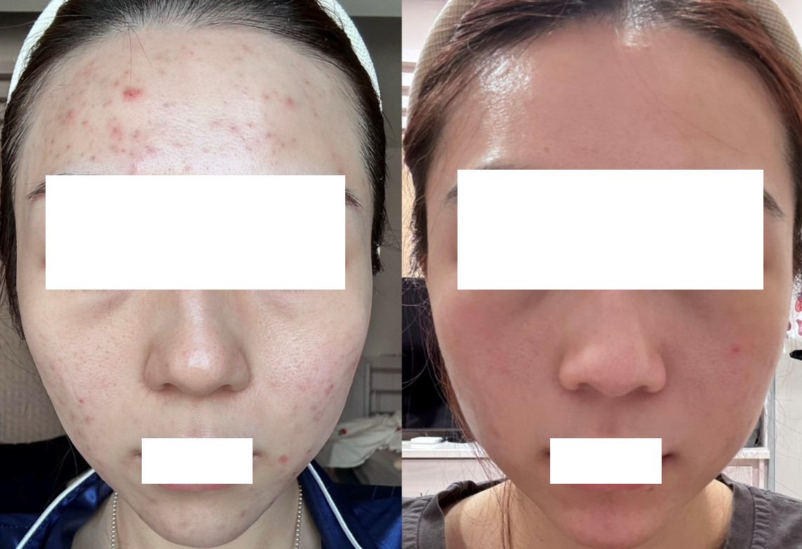 A醇泛紅的原因， A 醇紅腫怎麼辦？