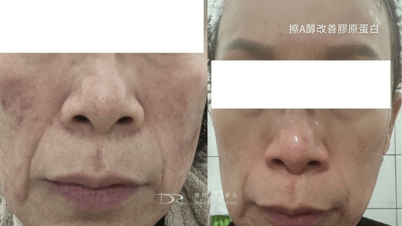 A醇泛紅的原因， A 醇紅腫怎麼辦？