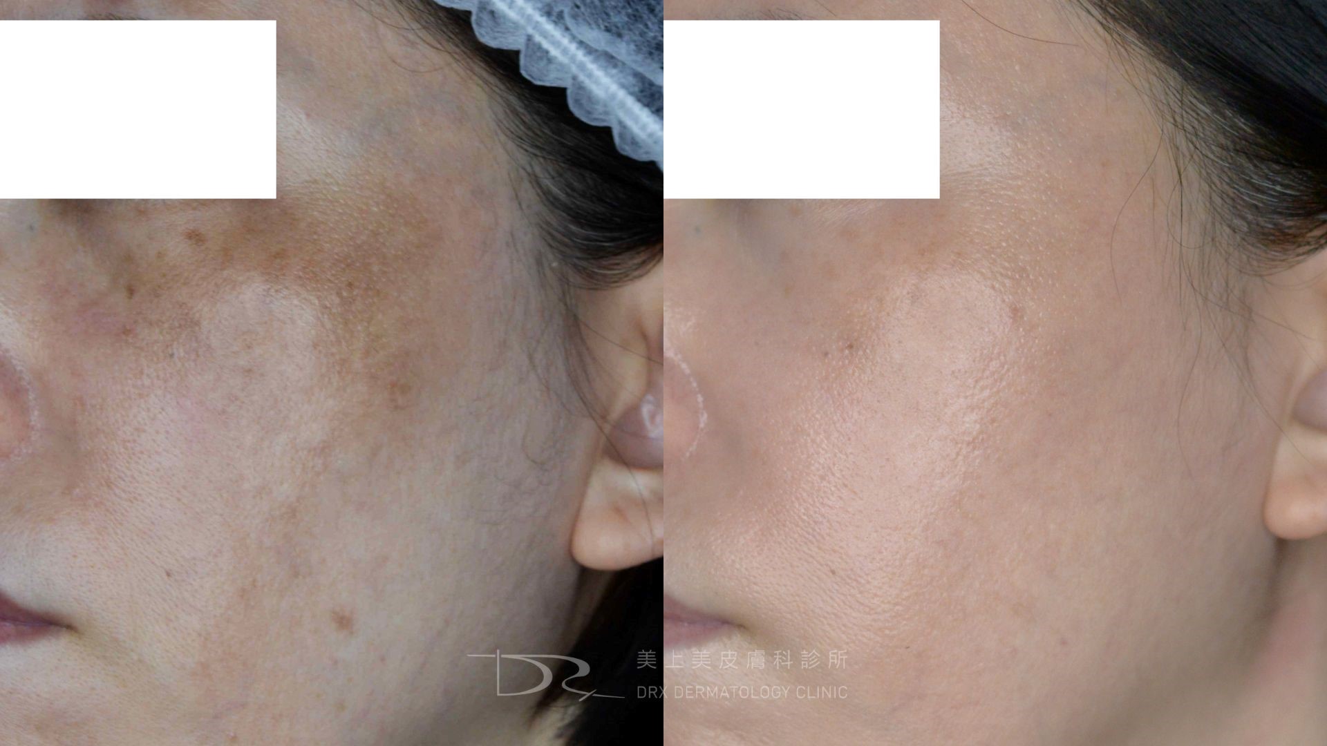 空氣不好會長痘痘嗎？室內空污會漲黑斑、讓皺紋會變多？