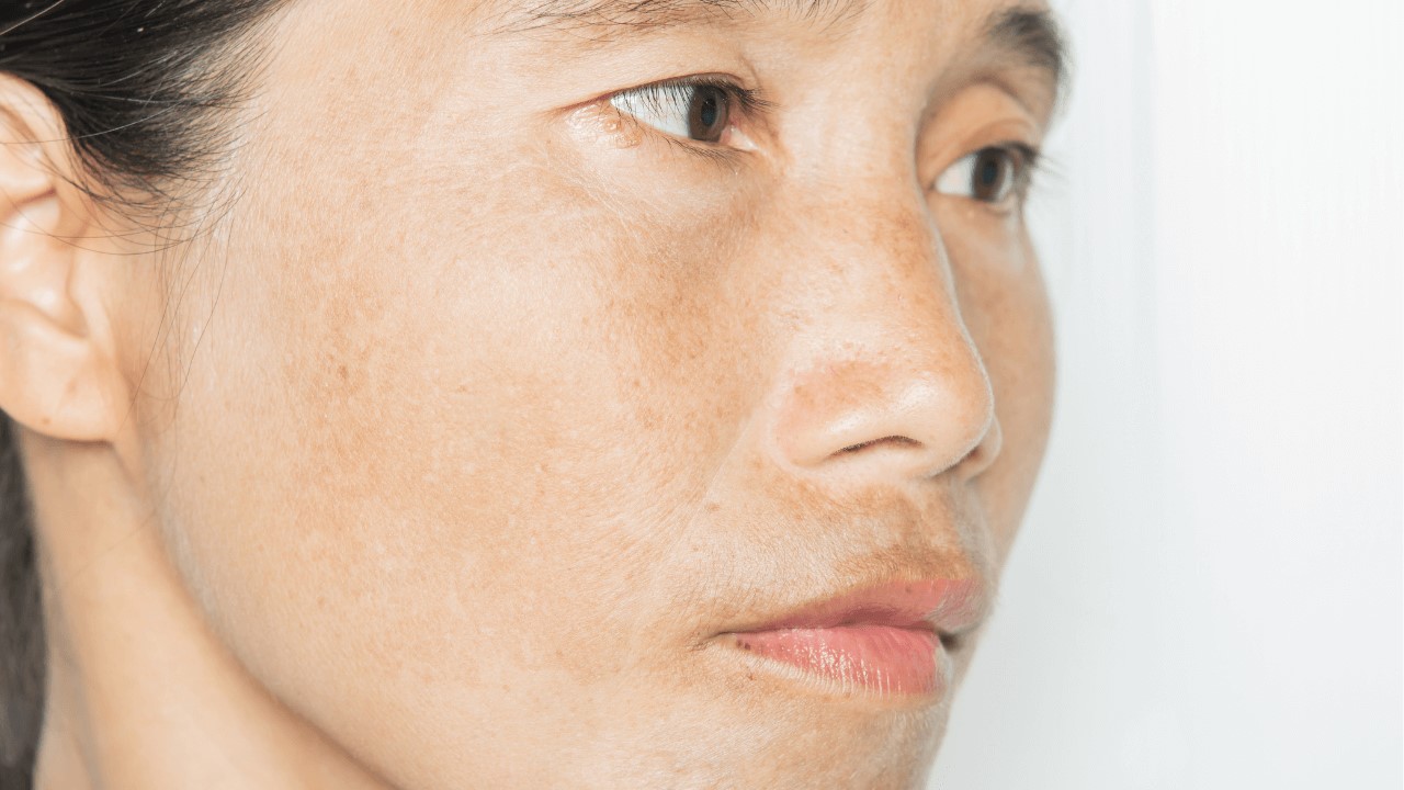 空氣不好會長痘痘嗎？室內空污會漲黑斑、讓皺紋會變多？