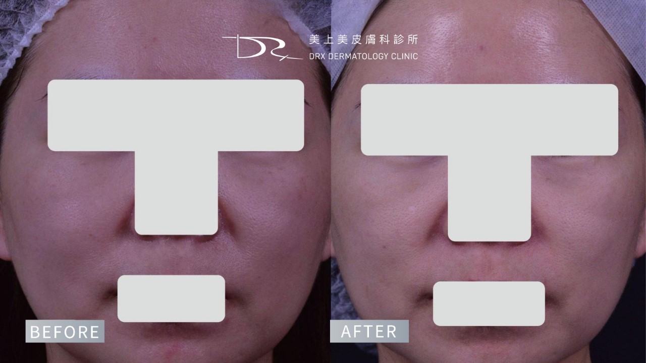 2026水光肌保養早晚步驟!熱門水光肌保養品成分、水光肌醫美療程一次看! 2026水光肌保養早晚步驟!熱門水光肌保養品成分、水光肌醫美療程一次看!