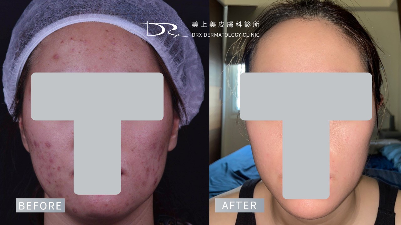 2026水光肌保養早晚步驟!熱門水光肌保養品成分、水光肌醫美療程一次看! 2026水光肌保養早晚步驟!熱門水光肌保養品成分、水光肌醫美療程一次看!