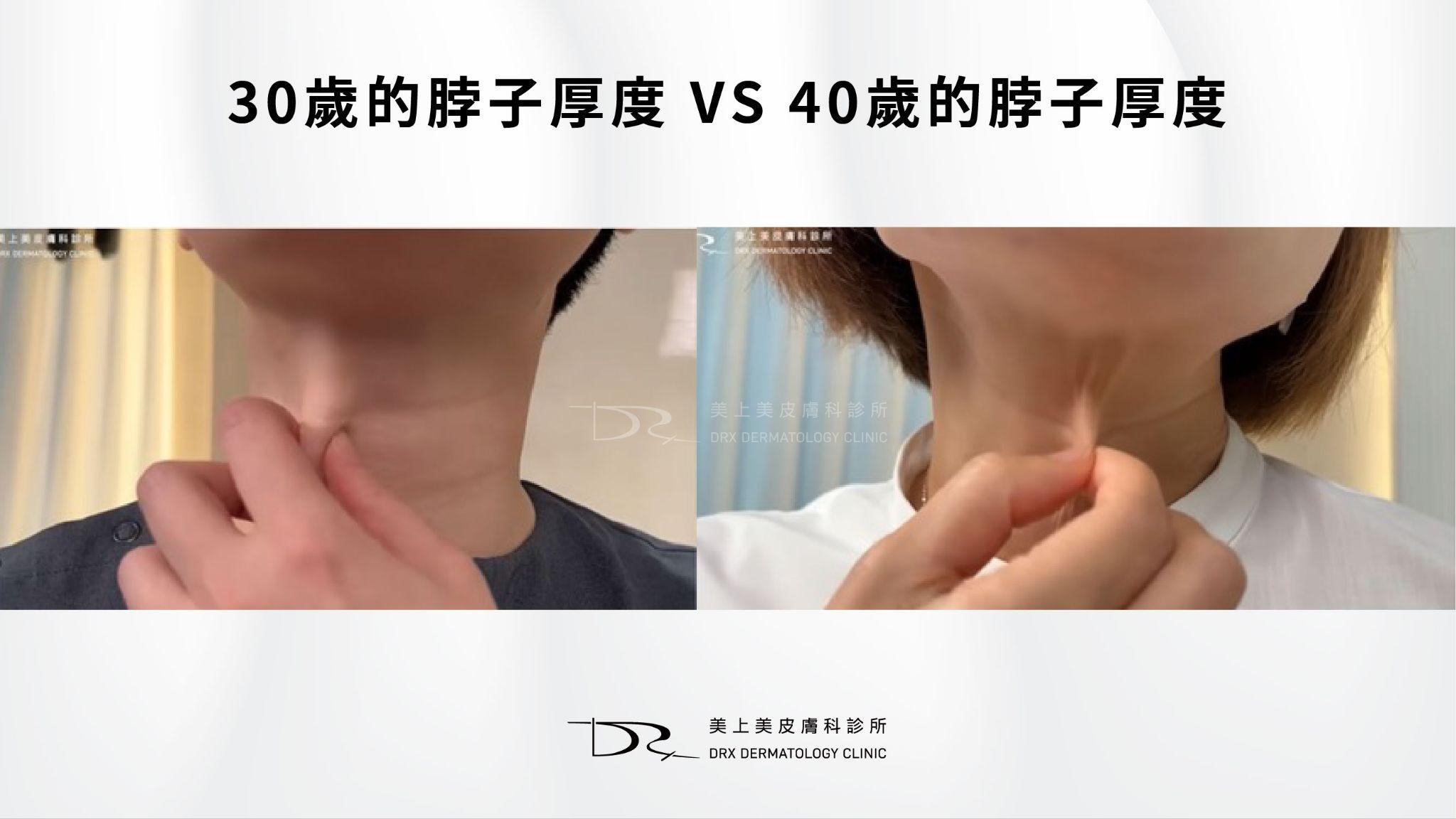 如何消除脖子紋？