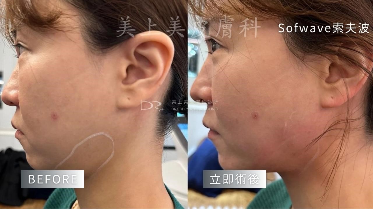 如何消除脖子紋？