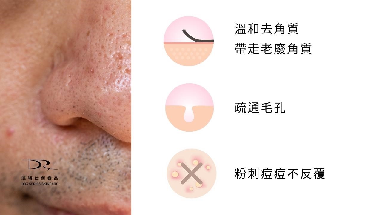 痘痘肌適合什麼化妝水? 痘痘肌適合什麼化妝水?