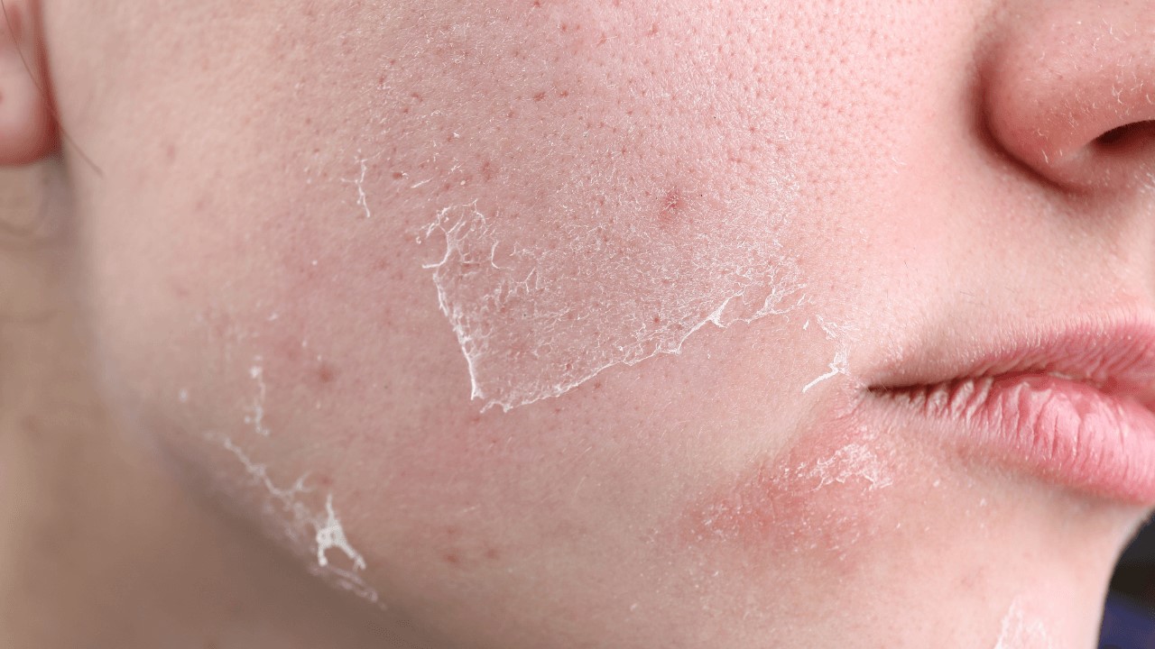 改善痘痘、淡化斑點、抗老，A醇哪個功效最強？