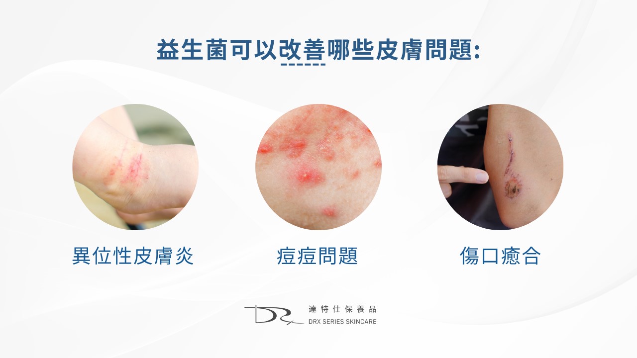 吃益生菌會讓皮膚變好嗎？吃益生菌對痘痘有幫助嗎？