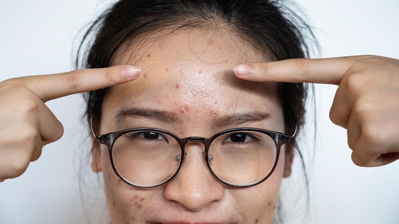 最近，還多了一種進化版本：把水楊酸直接加進痘痘貼裡。這樣對於青春痘有幫助嗎？這篇文章跟你說！