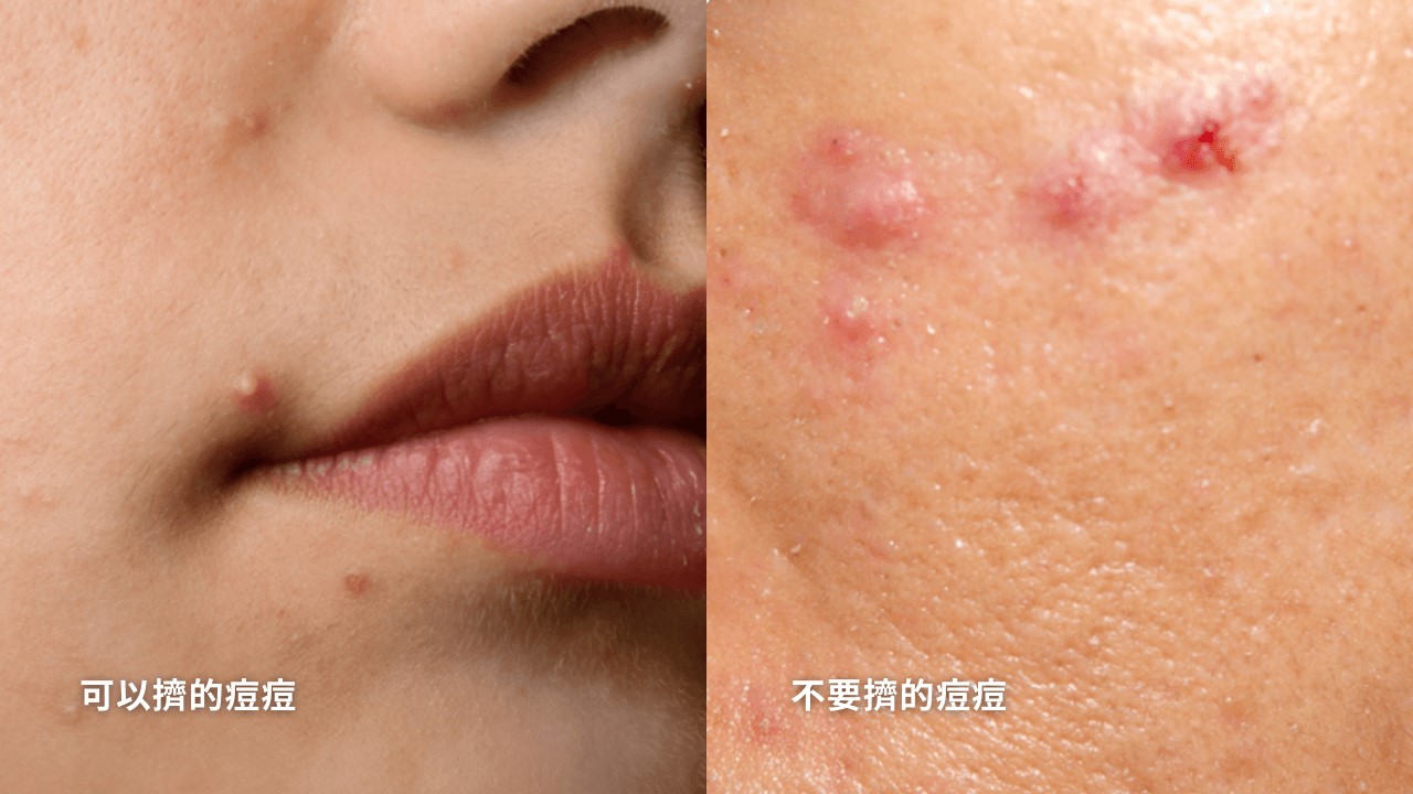 白色痘痘可以擠嗎？哪裡的痘痘不能擠？小心臉部危險三角區！