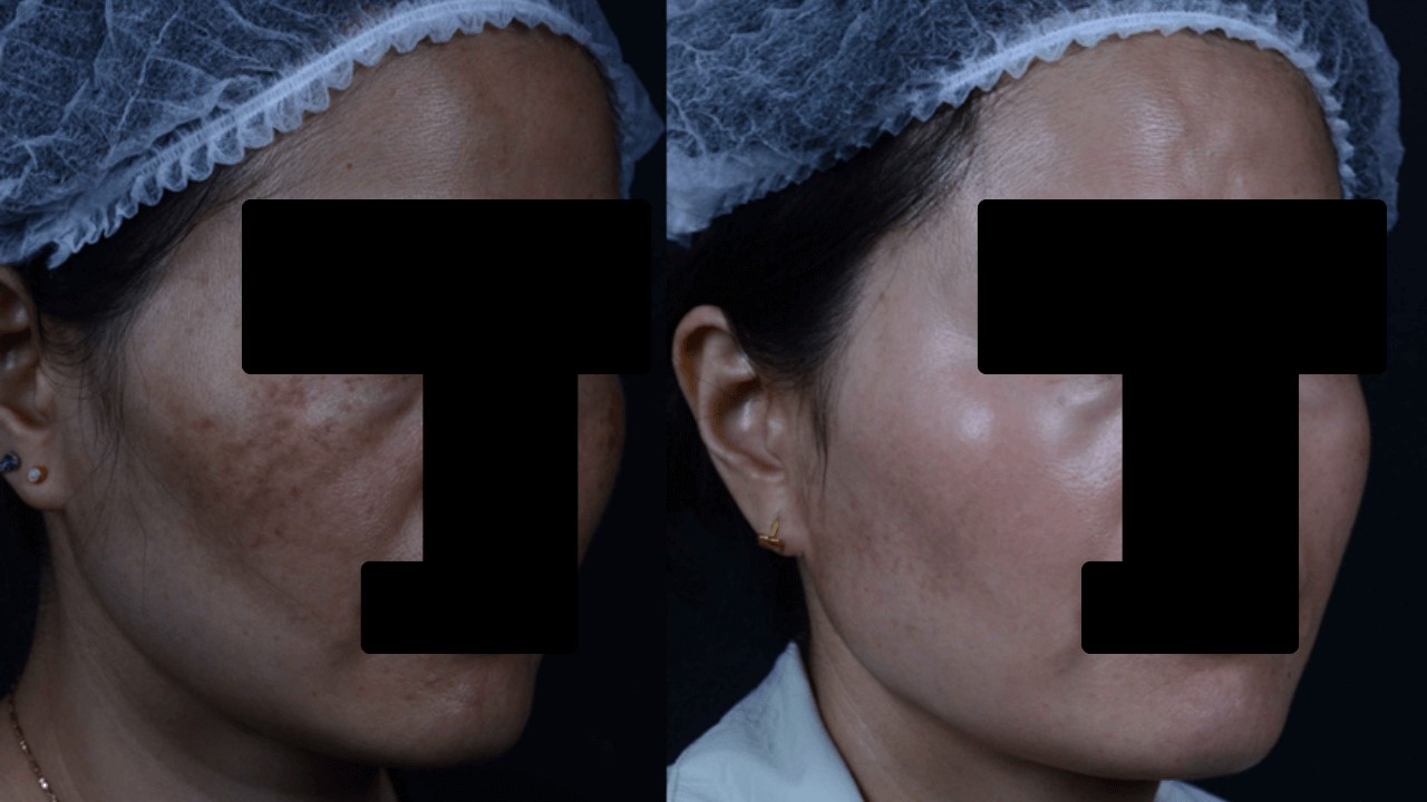 肝斑如何變淡?肝斑要擦什麼保養品? 肝斑如何變淡?肝斑要擦什麼保養品?