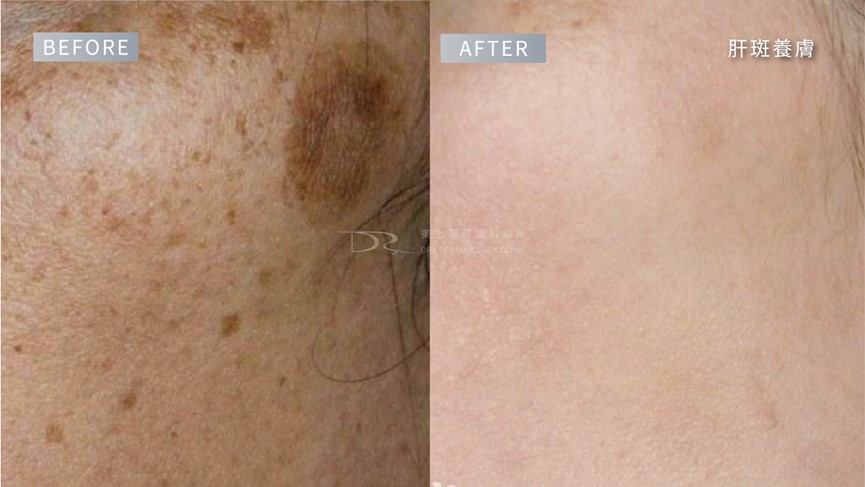 肝斑如何變淡?肝斑要擦什麼保養品? 肝斑如何變淡?肝斑要擦什麼保養品?