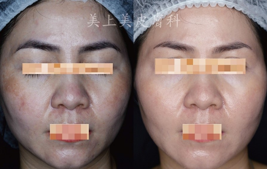 肝斑如何變淡?肝斑要擦什麼保養品? 肝斑如何變淡?肝斑要擦什麼保養品?