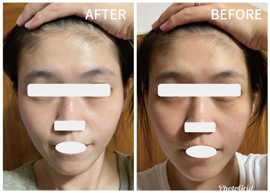 美白錠要吃多久才有效？ 傳明酸口服、穀胱甘肽點滴、美白針與口服維他命C美白完整攻略！