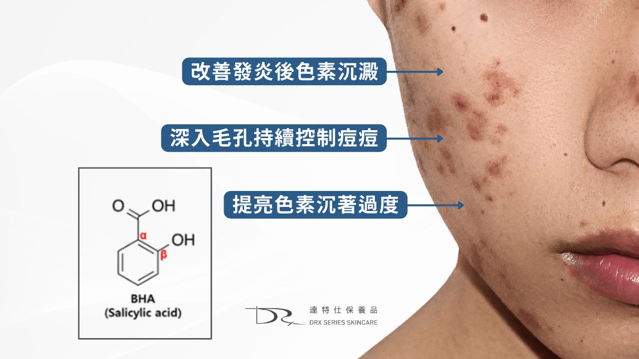 2026水楊酸功效完整解說：水楊酸會縮毛孔嗎? 水楊酸痘痘、水楊酸淡疤，果酸水楊酸差異一次搞懂！