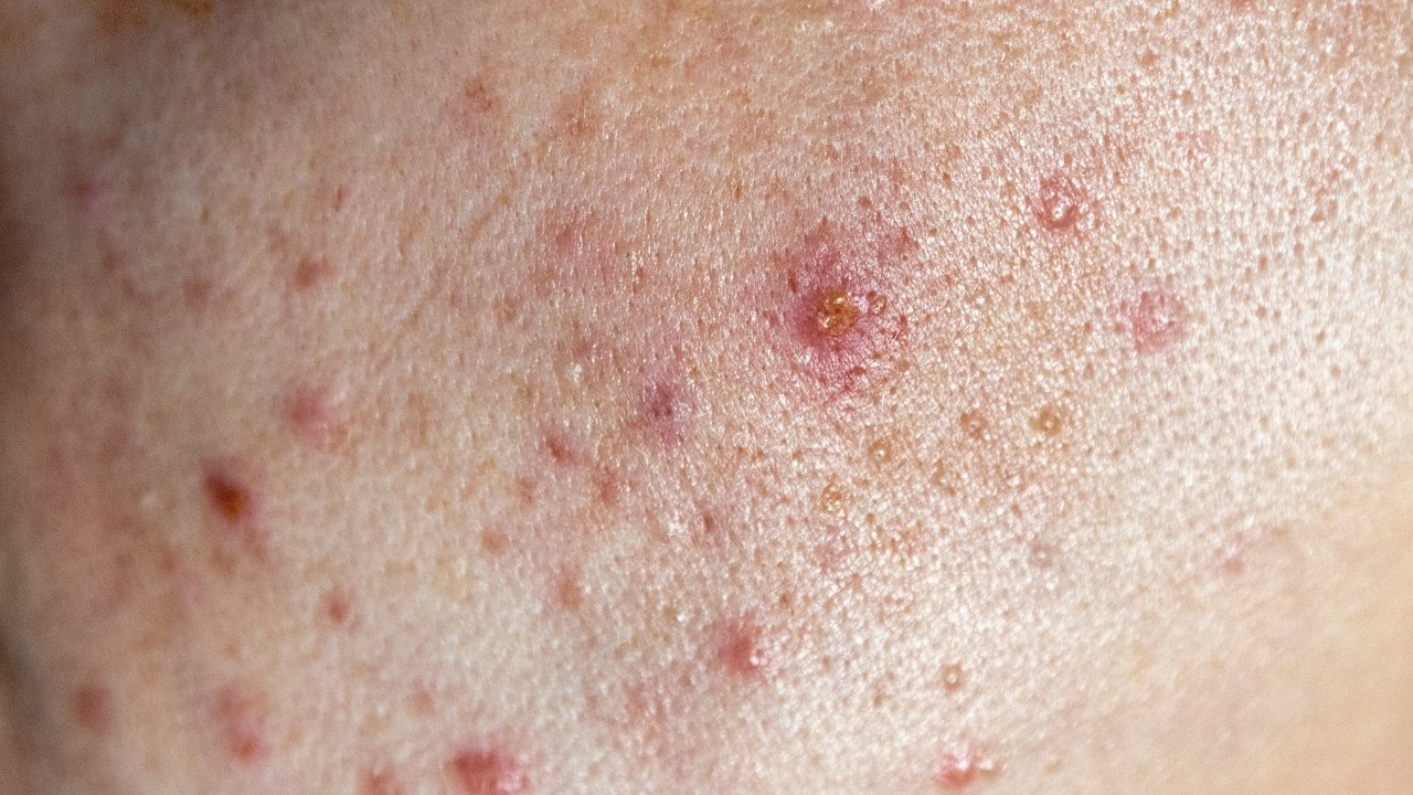 菸鹼醯胺可以淡化痘疤嗎？如何淡化痘印？