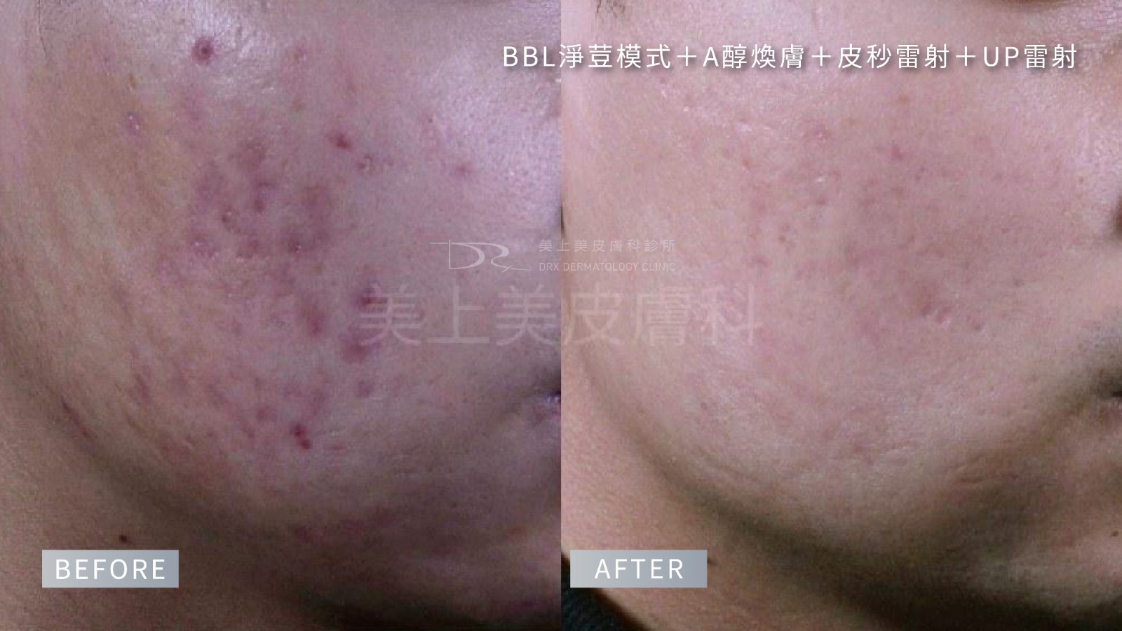 杜鵑花酸、A酸一起用：思媚乳膏用法、思麗安乳膏淡斑?紅痘疤杜鵑花酸保養方式！