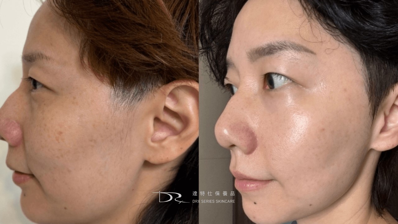 杜鵑花酸、A酸一起用：思媚乳膏用法、思麗安乳膏淡斑?紅痘疤杜鵑花酸保養方式！