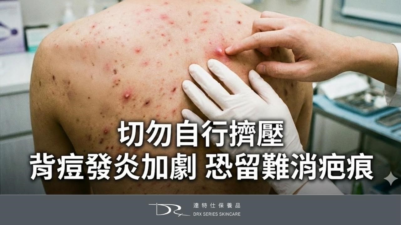 為什麼前胸後背會長痘痘?背痘原因一次解析 為什麼前胸後背會長痘痘?背痘原因一次解析