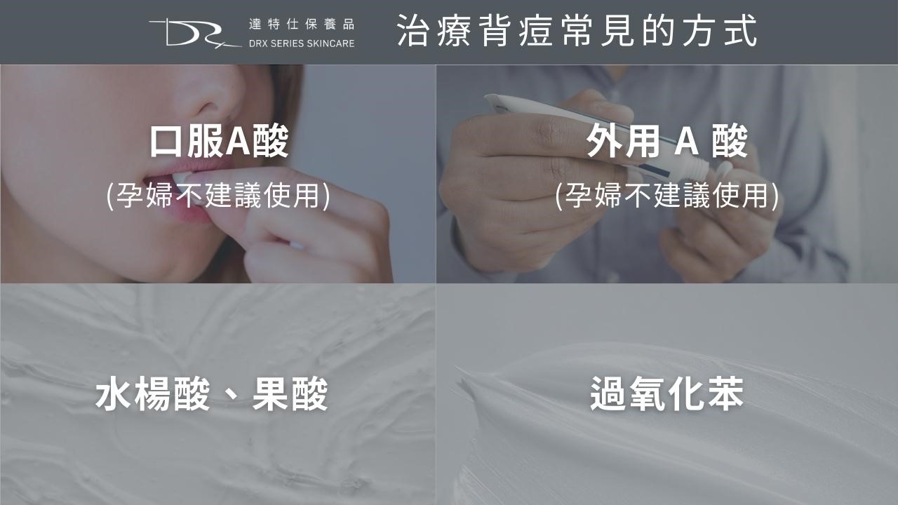 為什麼前胸後背會長痘痘?背痘原因一次解析 為什麼前胸後背會長痘痘?背痘原因一次解析