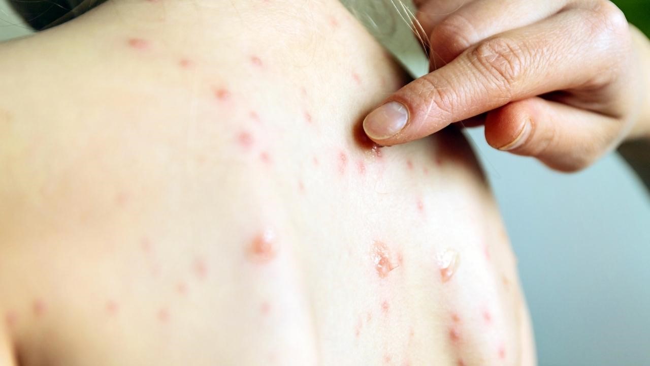 為什麼前胸後背會長痘痘?背痘原因一次解析 為什麼前胸後背會長痘痘?背痘原因一次解析