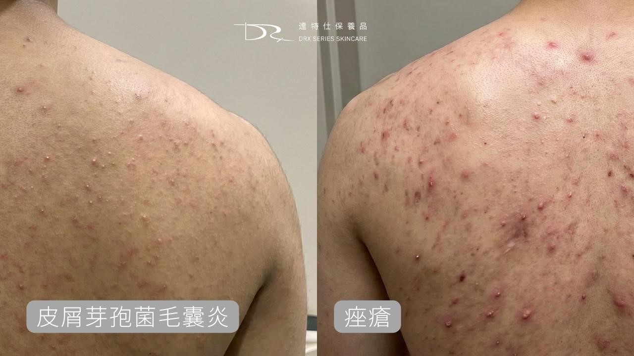 為什麼前胸後背會長痘痘?背痘原因一次解析 為什麼前胸後背會長痘痘?背痘原因一次解析