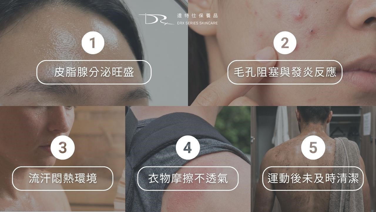 為什麼前胸後背會長痘痘?背痘原因一次解析 為什麼前胸後背會長痘痘?背痘原因一次解析