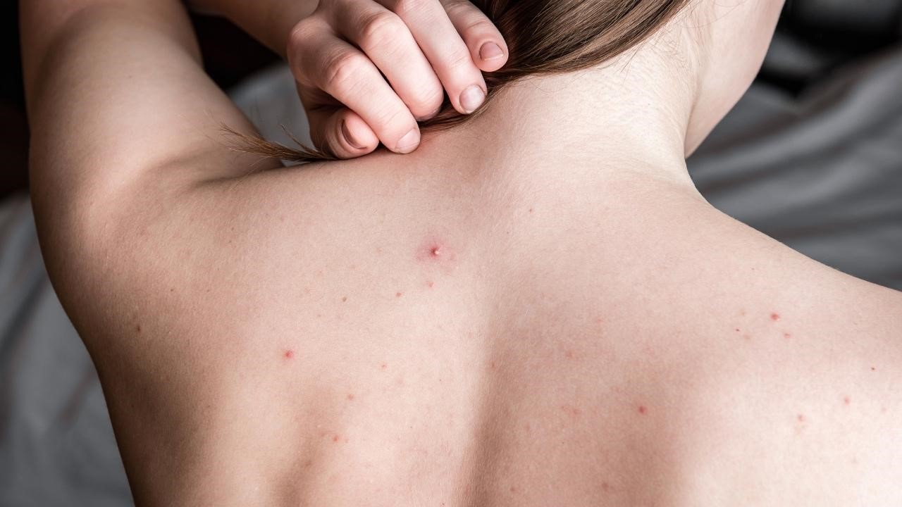 為什麼前胸後背會長痘痘?背痘原因一次解析 為什麼前胸後背會長痘痘?背痘原因一次解析