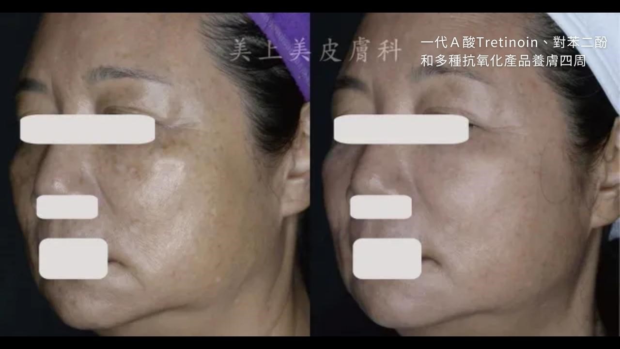 一代a酸特蒂樂乳膏效果？一代A酸抗老嗎？