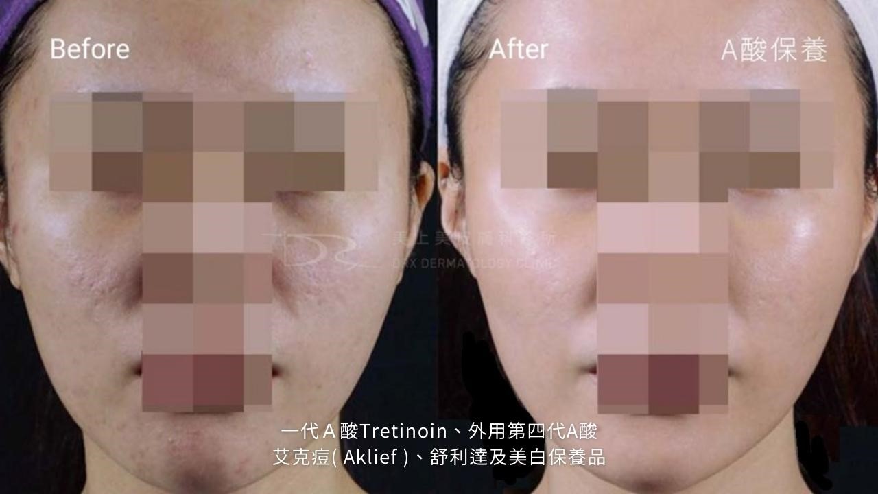 一代a酸特蒂樂乳膏效果？一代A酸抗老嗎？