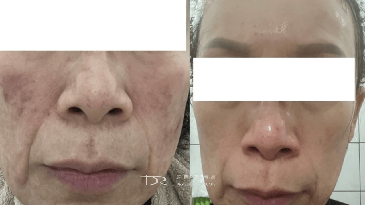 皮膚薄怎麼改善，補充膠原蛋白的方法？破壞膠原蛋白食物清單？