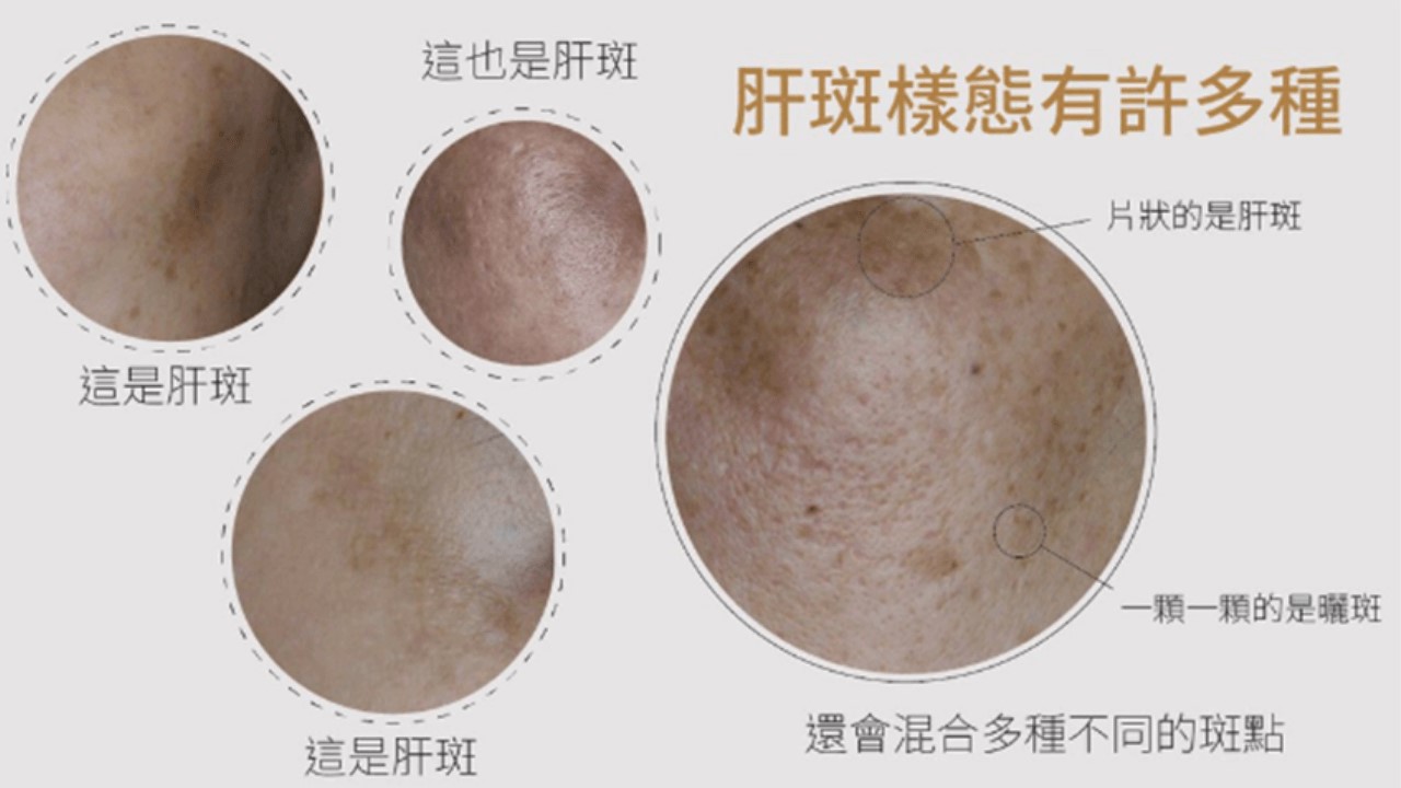 活力白乳膏有效嗎？快樂乳膏評價？對苯二酚致癌？對苯二酚反黑？