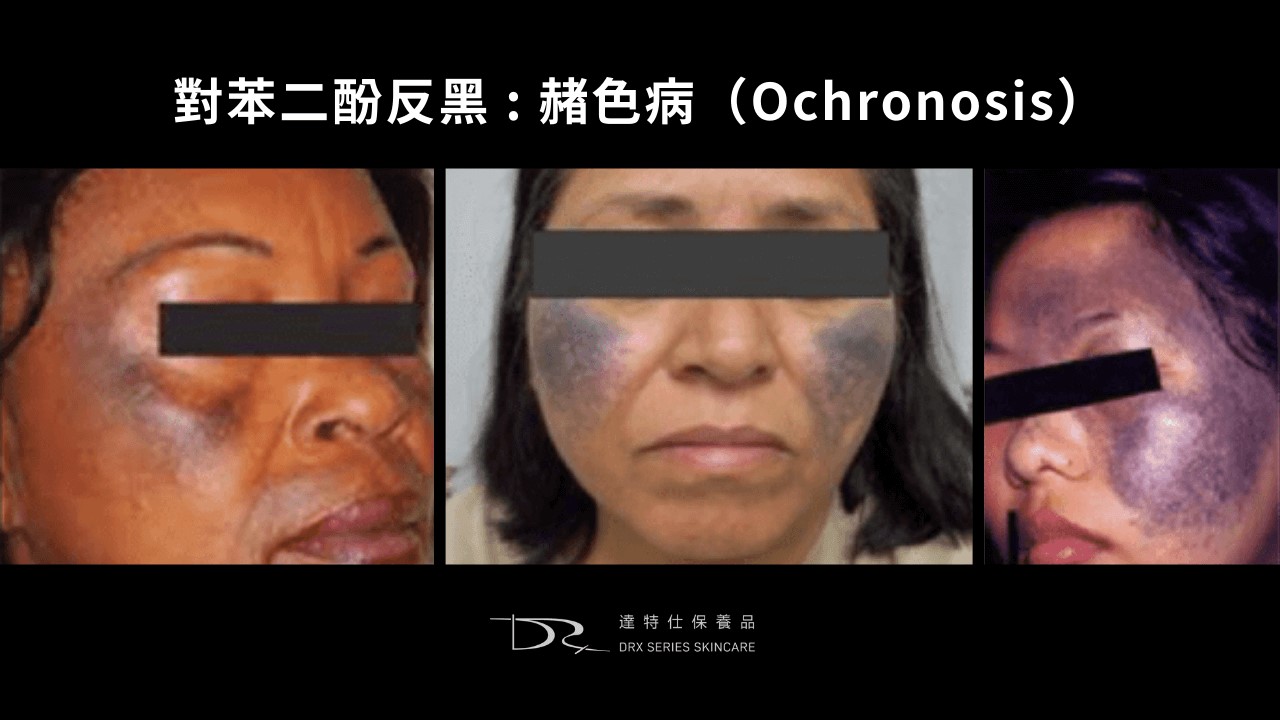 活力白乳膏有效嗎？快樂乳膏評價？對苯二酚致癌？對苯二酚反黑？