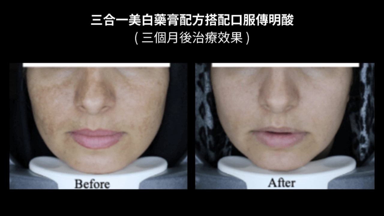 活力白乳膏有效嗎？快樂乳膏評價？對苯二酚致癌？對苯二酚反黑？