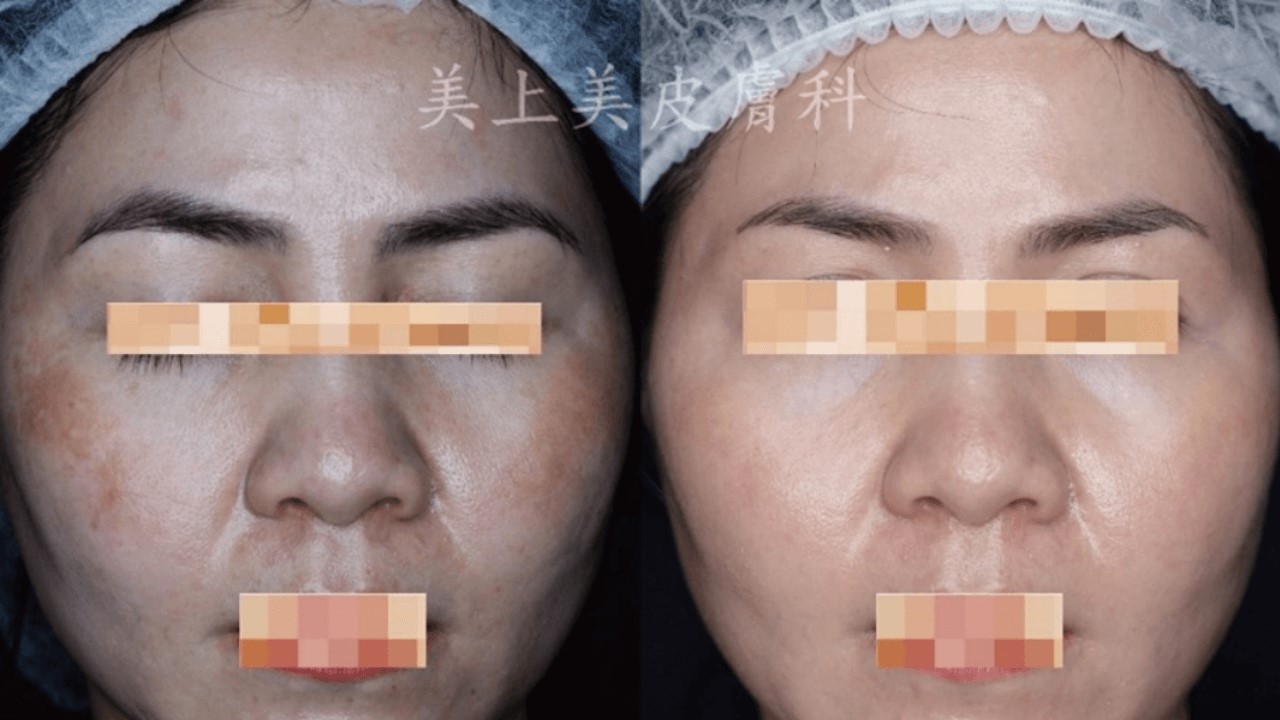 活力白乳膏有效嗎？快樂乳膏評價？對苯二酚致癌？對苯二酚反黑？